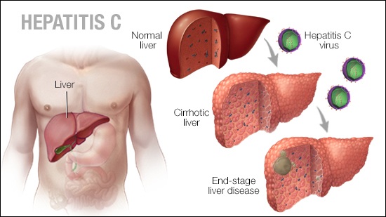 Hepatitis c symptoms