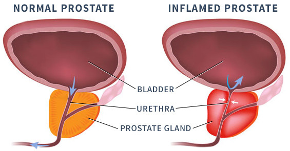 prostatitis és hepatitis