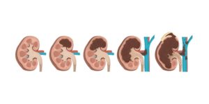 Kidney-Cancer_symptoms