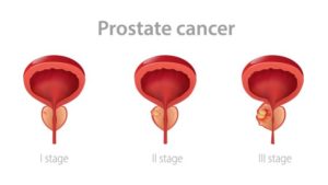 Prevent Prostate Cancer