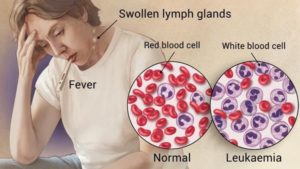  chronic lymphocytic leukemia