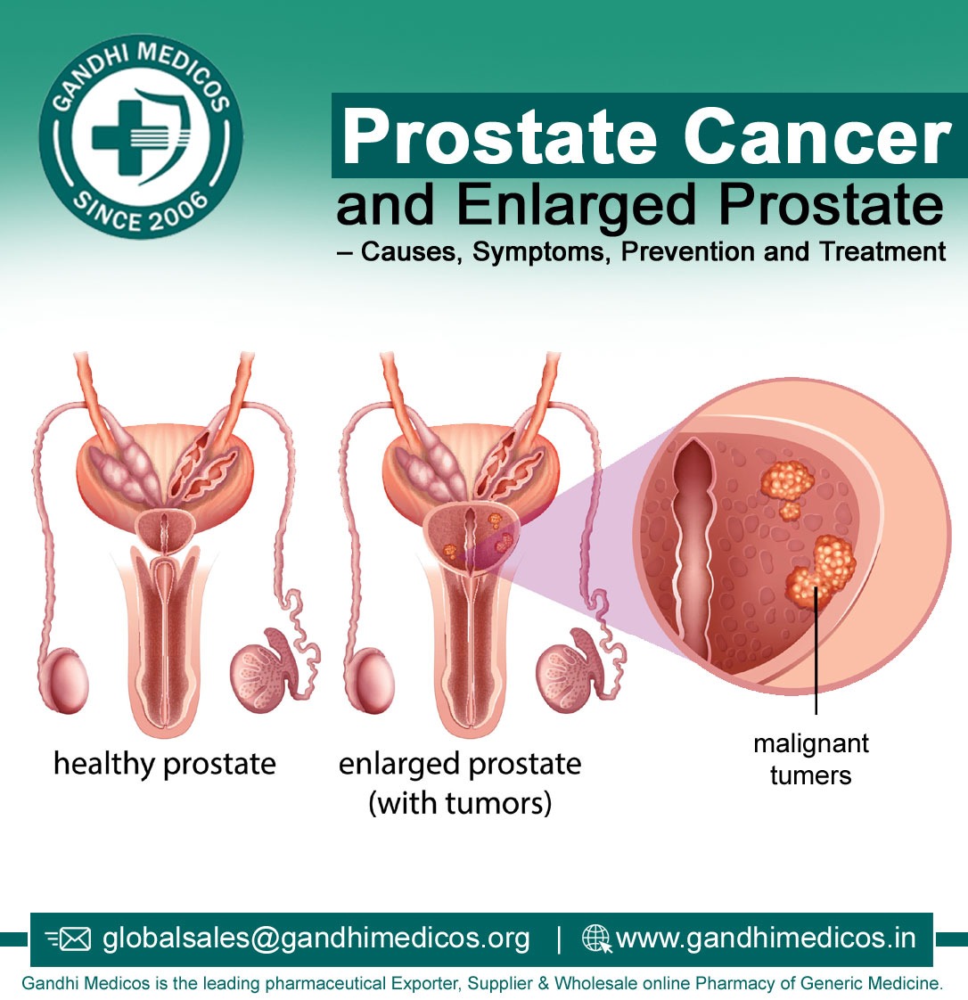 Prostate Cancer and Enlarged Prostate