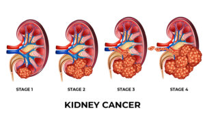 kidney cance early symptoms
